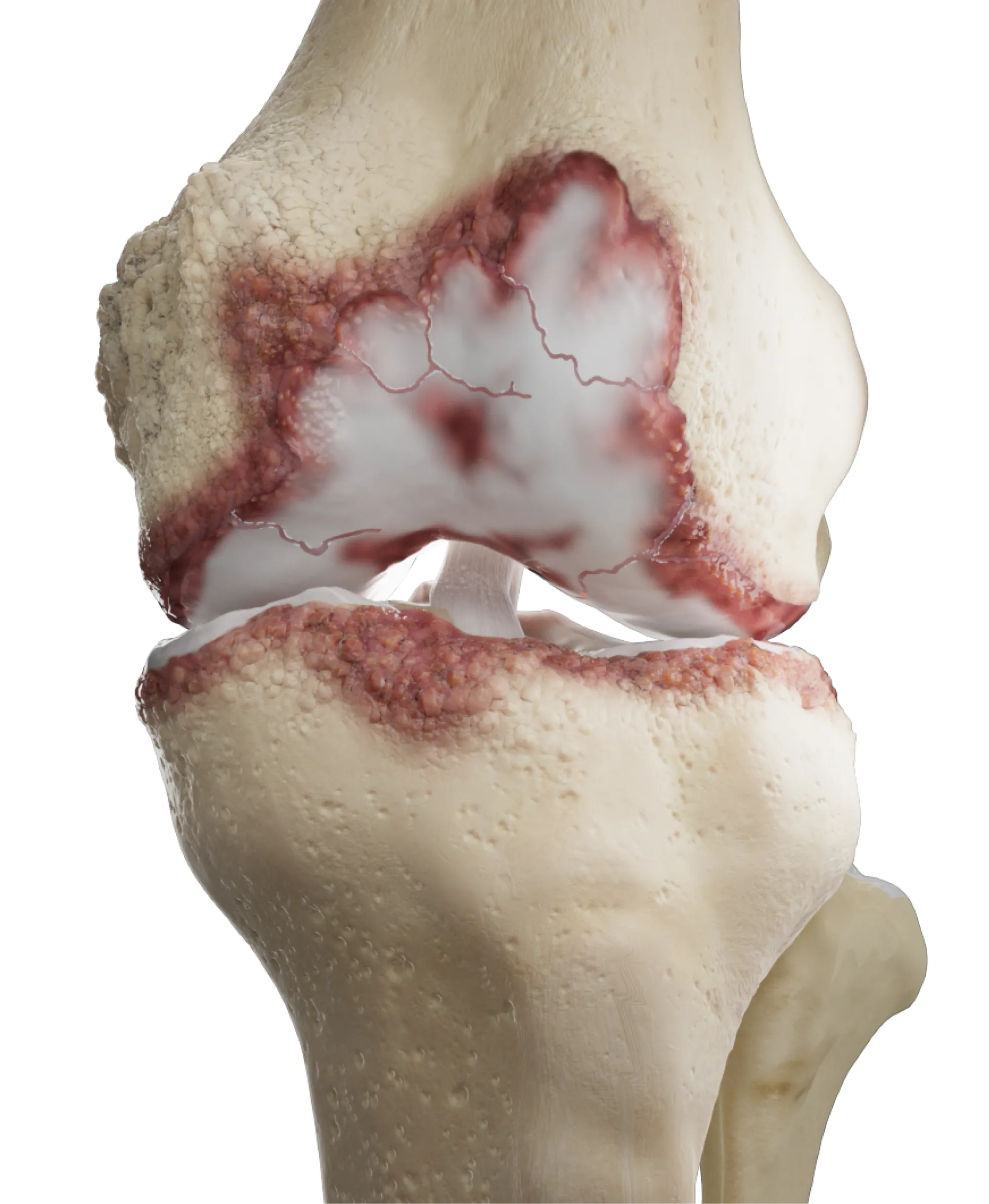 A close-up computer-generated skeletal image of a knee with damage