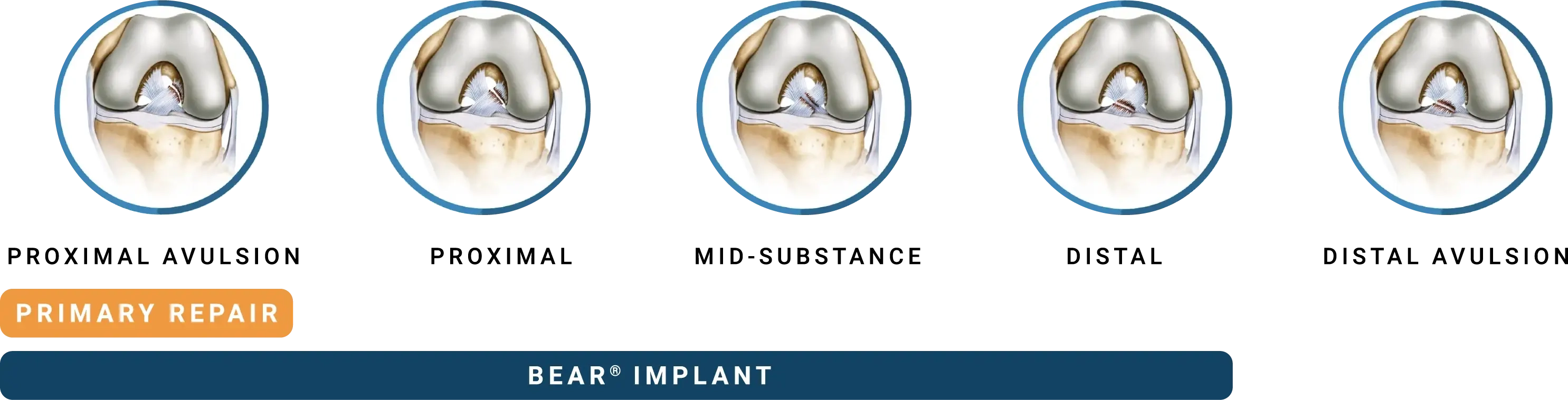 Tear types diagram